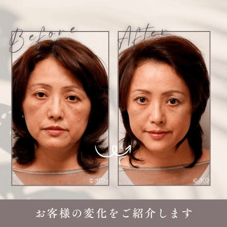 表皮と筋肉、そして肌細胞にアプローチする3つの美肌メソッド